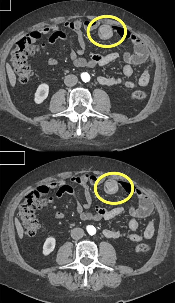 Schwannoma Small Bowel