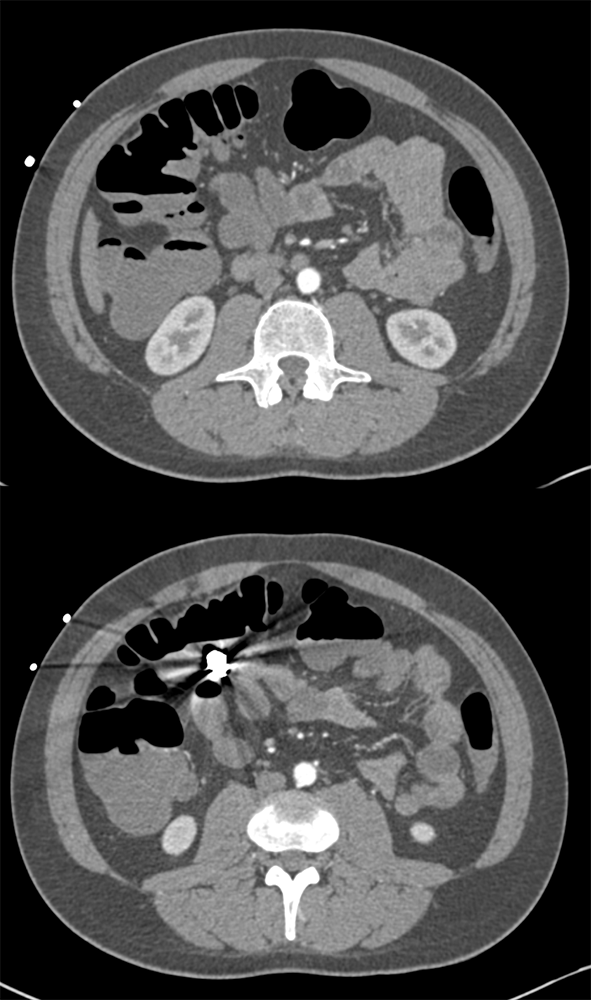 Abdominal Pain and GI Bleed