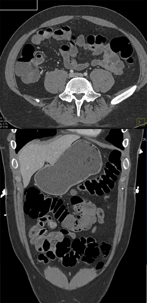 CT of GI Bleed