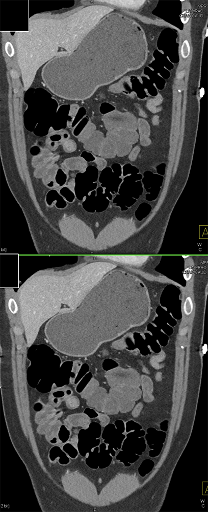 CT of GI Bleed