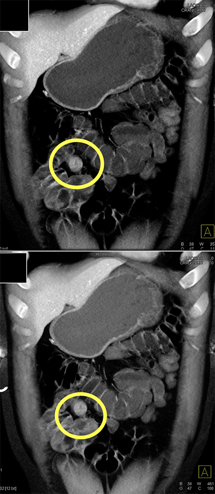 CT of GI Bleed