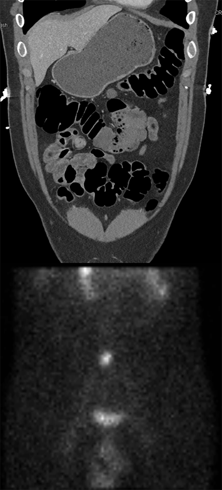 CT of GI Bleed