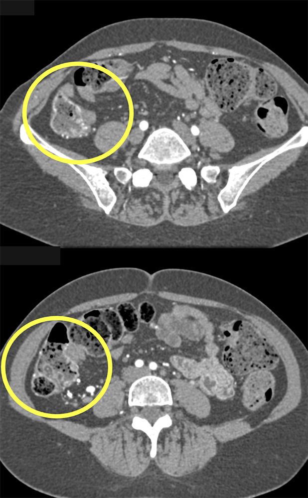 Role of Imaging Vascular Maps Beyond Axial Plane