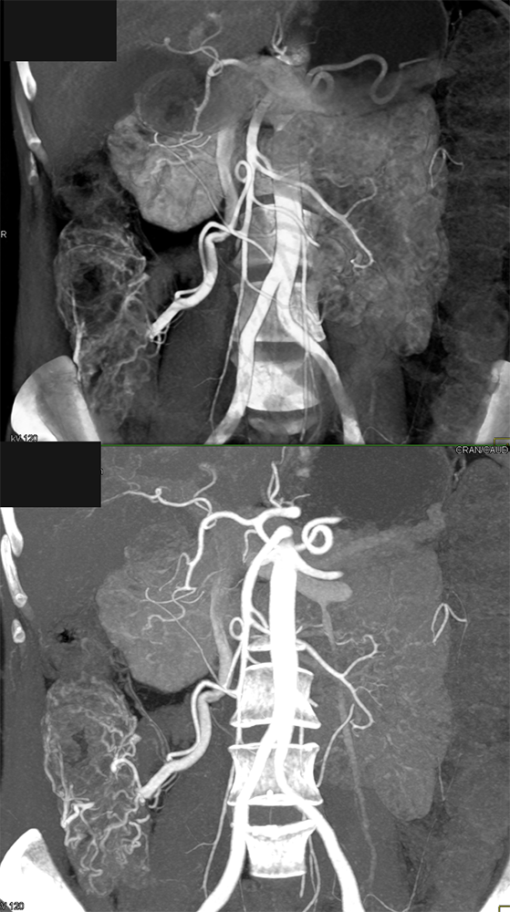 CT of GI Bleed