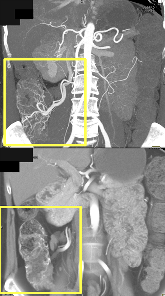 CT of GI Bleed