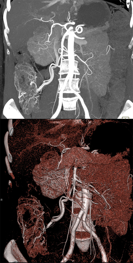 Angiodysplasia