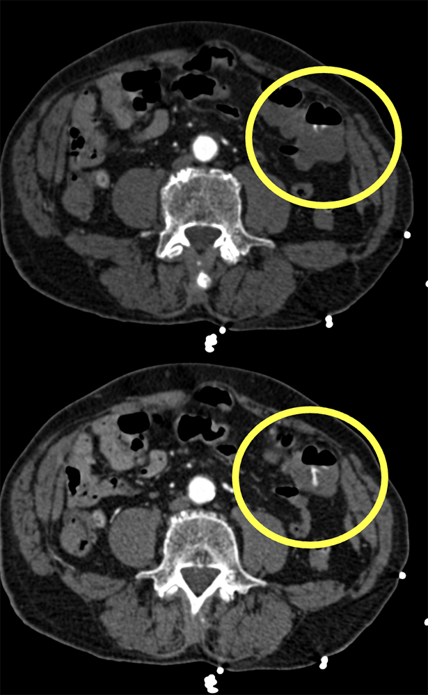 GI Bleed due to Diverticulitis Missed on Arterial Phase