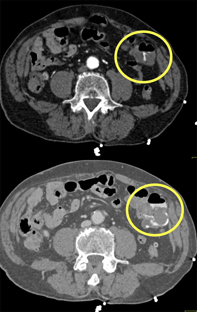 CT of GI Bleed