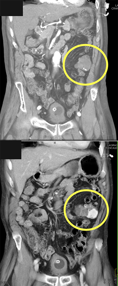 CT of GI Bleed