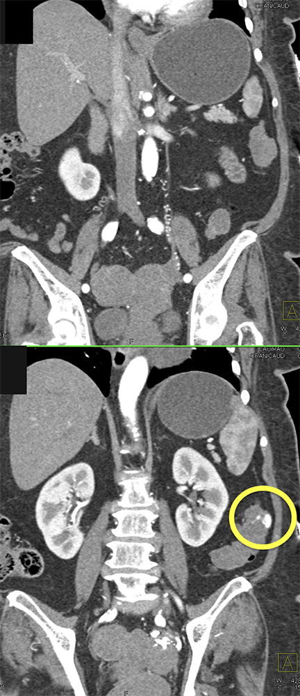 Abdominal Pain and GI Bleeding: ? Etiology