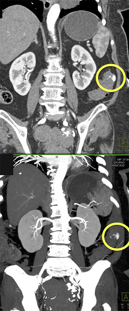 CT of GI Bleed