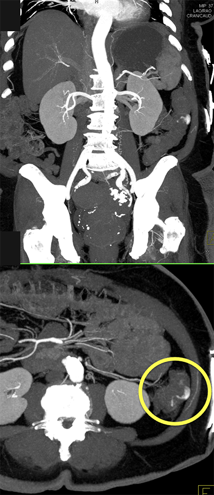 CT of GI Bleed