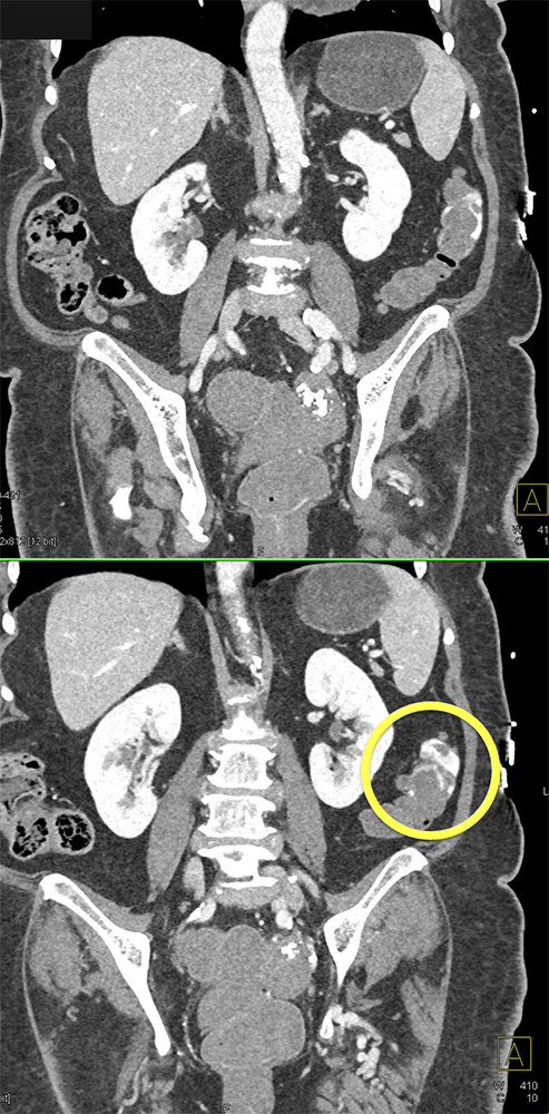 CT of GI Bleed