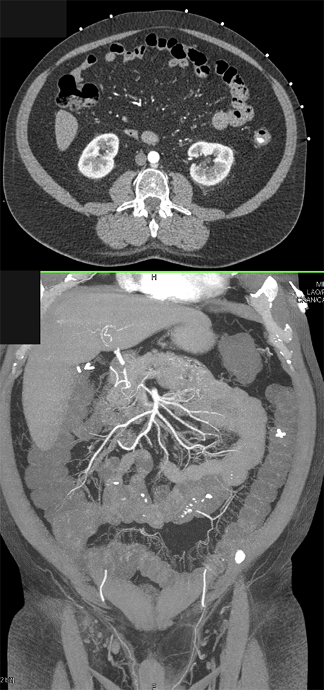 Active GI Bleed from Diverticulosis