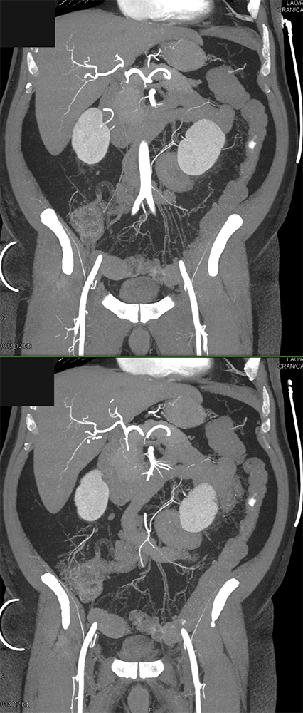 CT of GI Bleed