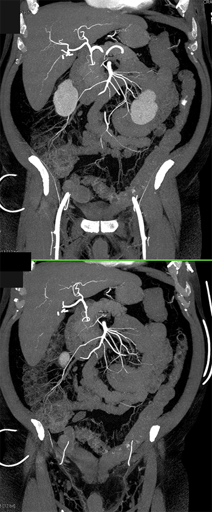 CT of GI Bleed