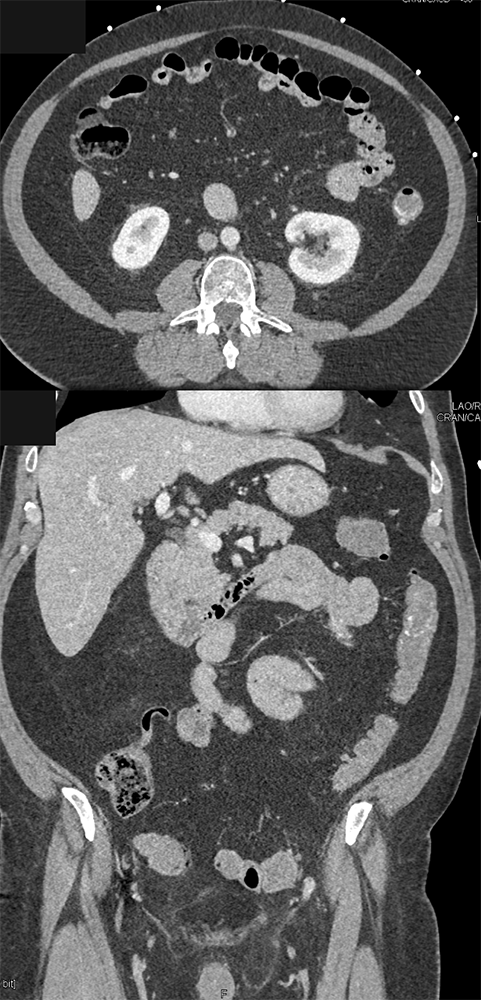 CT of GI Bleed