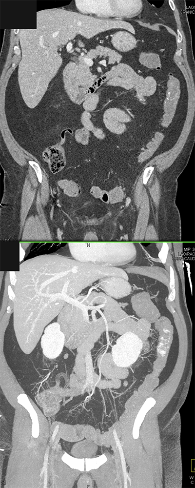 CT of GI Bleed