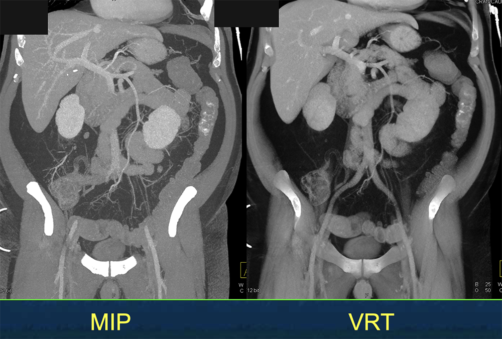 CT of GI Bleed