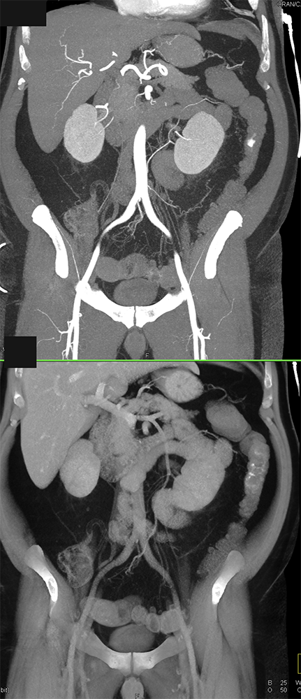 CT of GI Bleed