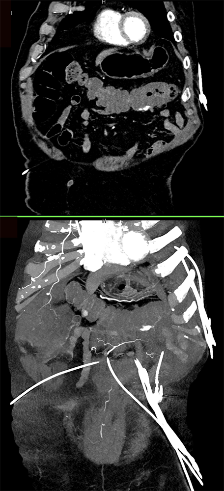 Bleeding Diverticulitis in Transverse Colon and Sigmoid