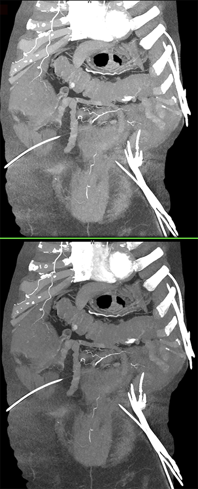 CT of GI Bleed