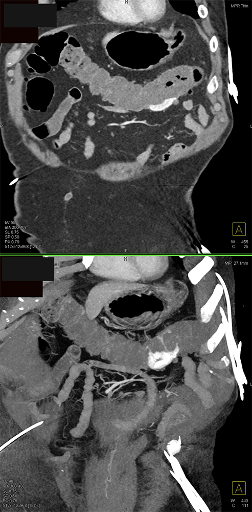 CT of GI Bleed