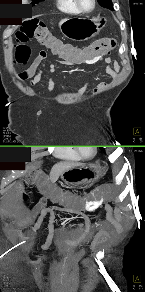 CT of GI Bleed