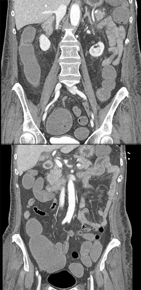 GI Bleed due to Ulcer on Iliocecal Valve