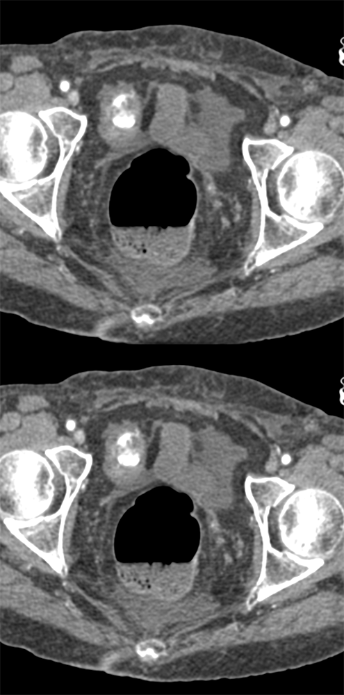 CT of GI Bleed