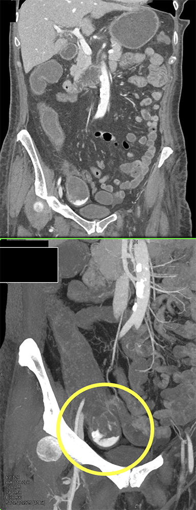 CT of GI Bleed