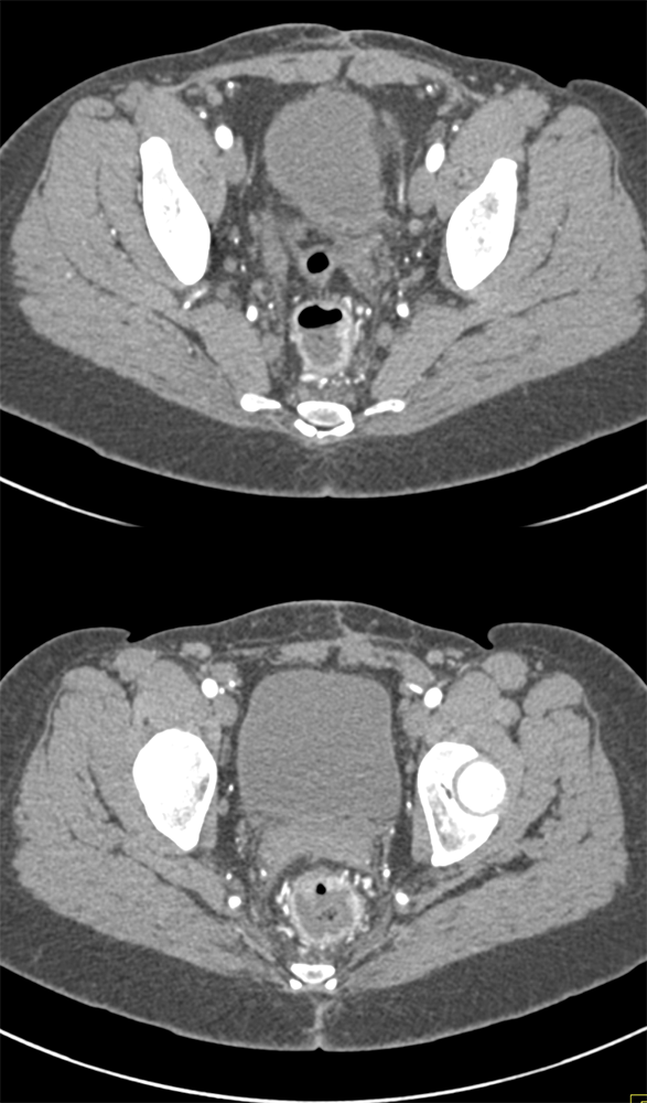 Rectal Enhancement and Bleed Due to Ulcerative Colitis 