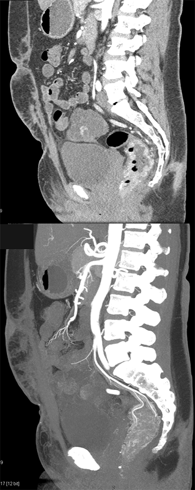 CT of GI Bleed