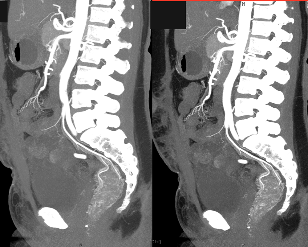 CT of GI Bleed