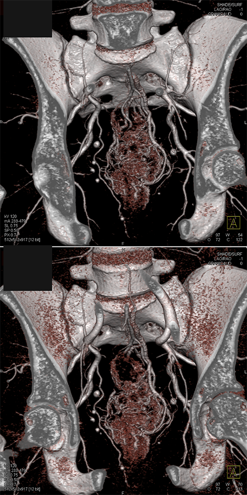 CT of GI Bleed