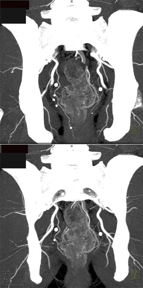 CT of GI Bleed