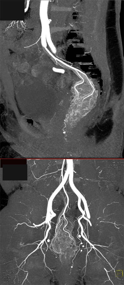 CT of GI Bleed