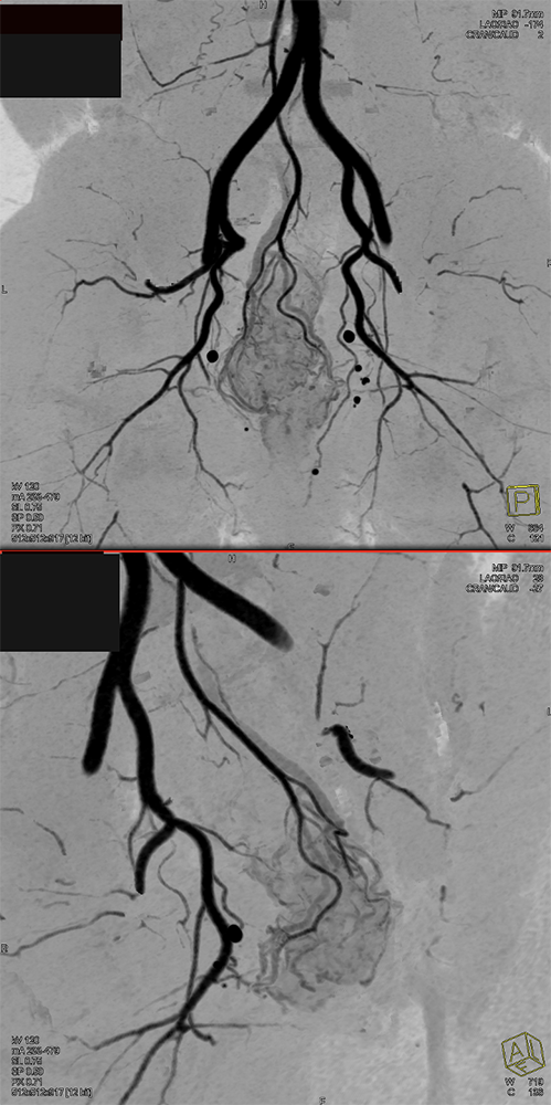 CT of GI Bleed