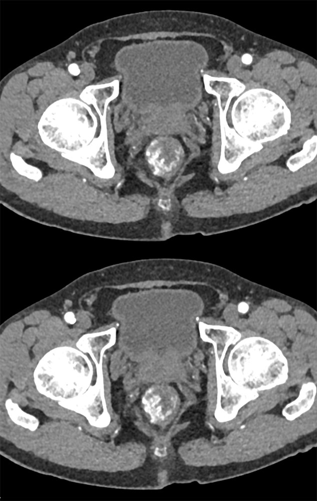 Rectal Varices and GI Bleed