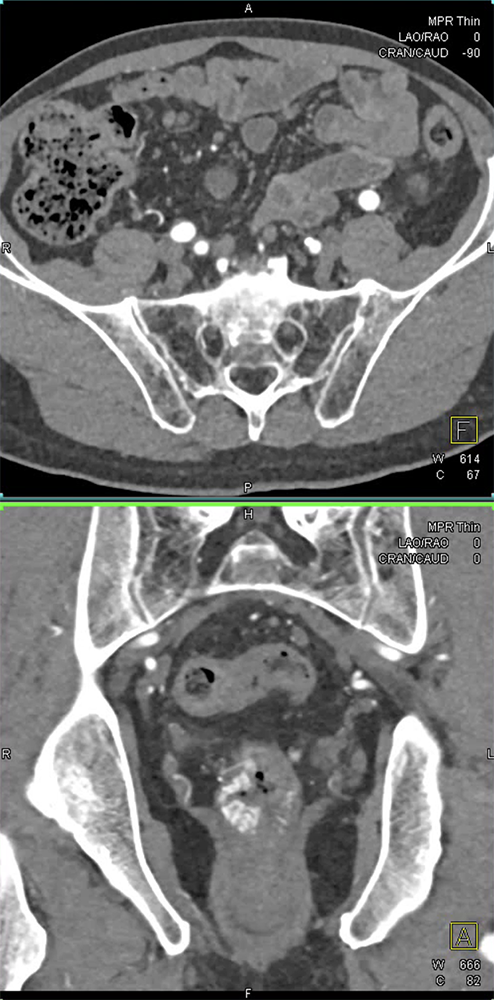 CT of GI Bleed