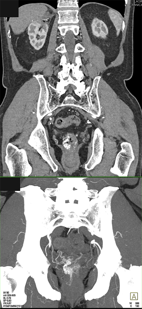 CT of GI Bleed