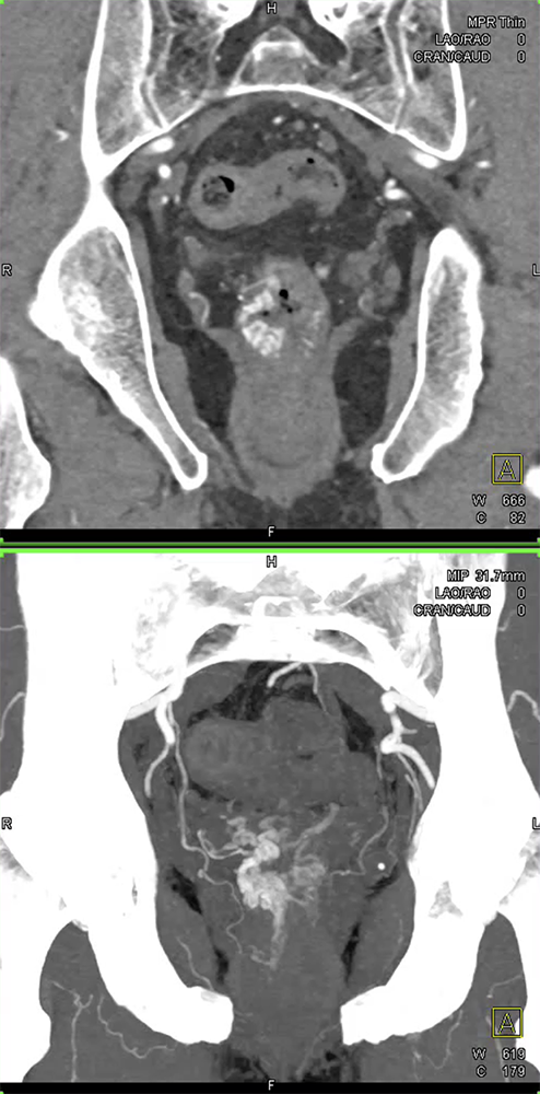 CT of GI Bleed