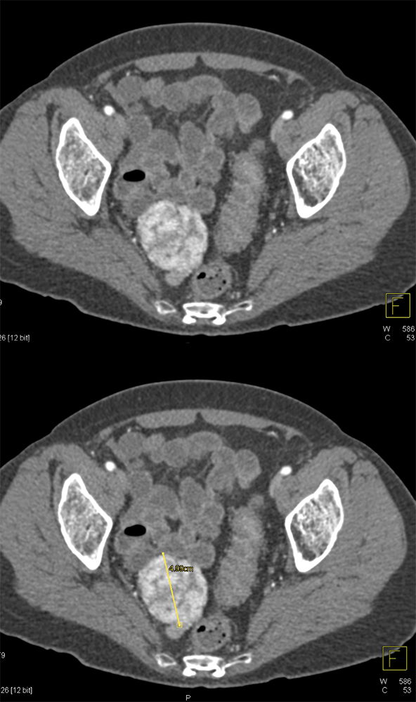 GI Bleed with Leiomyoma Ileum with Negative Capsule Study