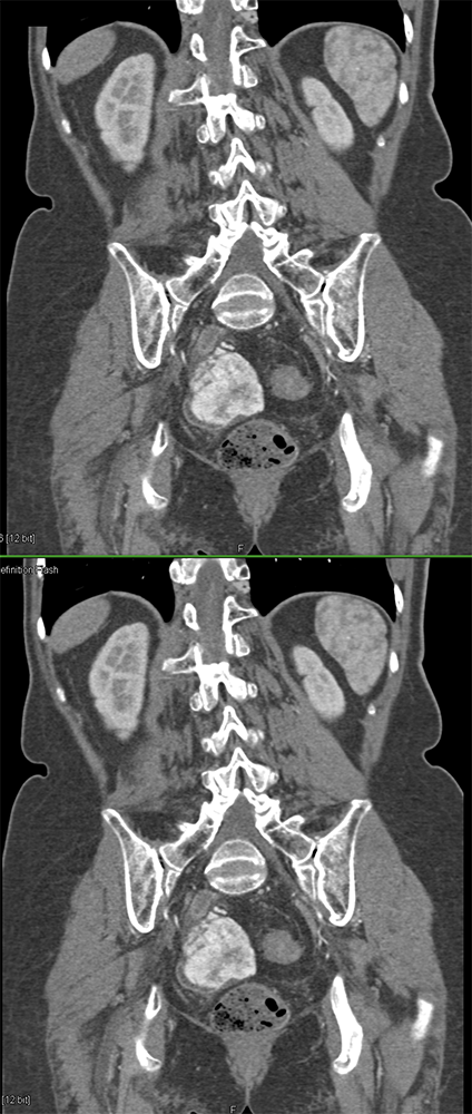 CT of GI Bleed