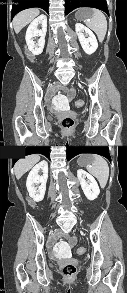 CT of GI Bleed