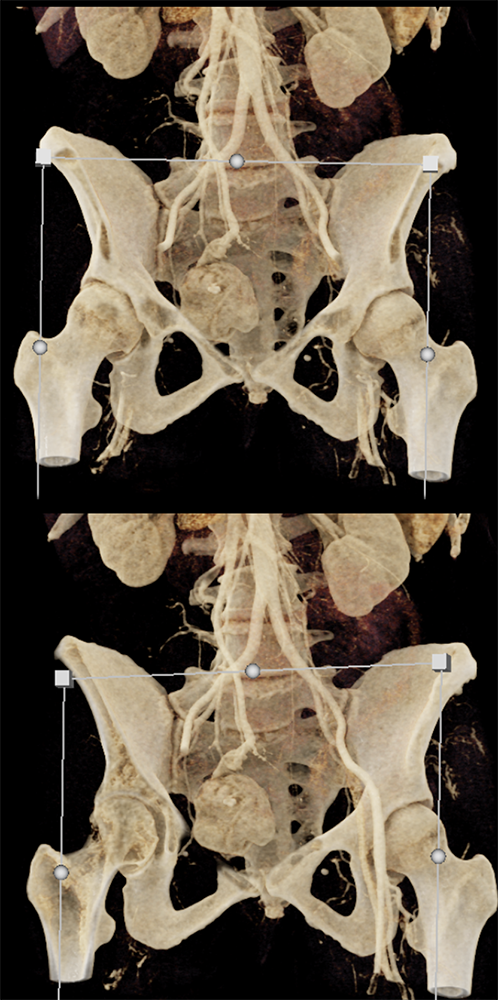 CT of GI Bleed