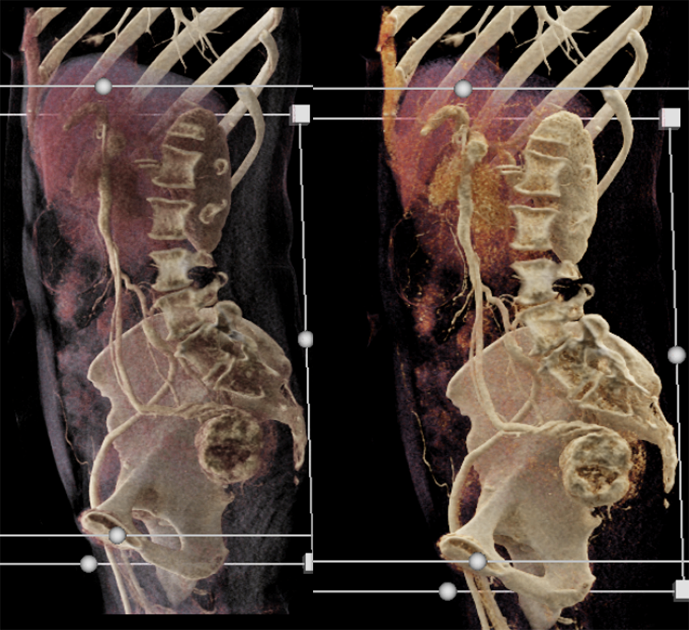 CT of GI Bleed