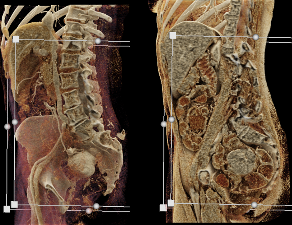 CT of GI Bleed