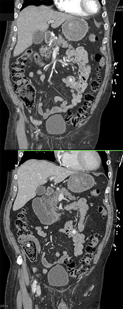 CT of GI Bleed