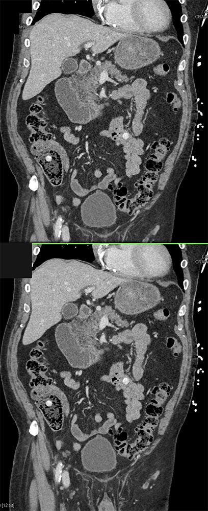 CT of GI Bleed